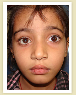 Artificial Eye in india,artificial eye in punjab, Eye prosthesis in india, artifical eyes, artificial eye jalandhar,artificial eye in punjab,Eye prosthesis in jalandhar,Eye prosthesis in punjab