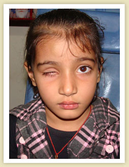 Artificial Eye in india,artificial eye in punjab, Eye prosthesis in india, artifical eyes, artificial eye jalandhar,artificial eye in punjab,Eye prosthesis in jalandhar,Eye prosthesis in punjab